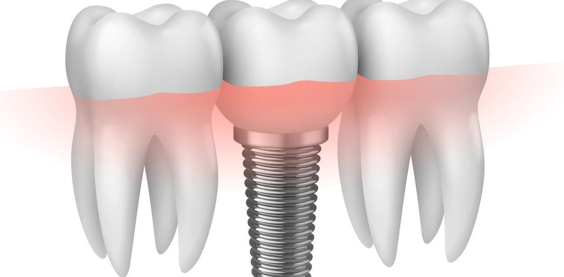implant-unitaire-centre-implantologie-teintureries-tarare