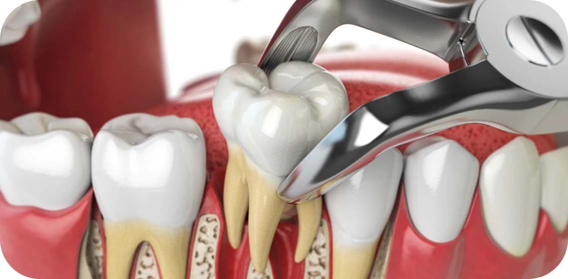 extraction-dentaire-dentistes-tarare