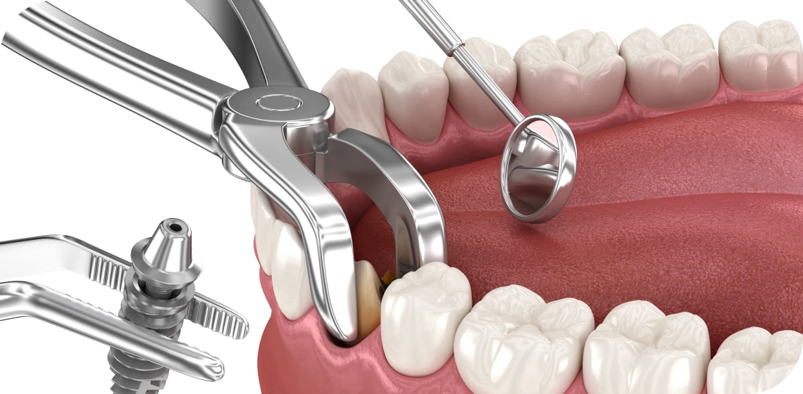 extraction-implantation-immediate-centre-implantologie-teintureries-tarare