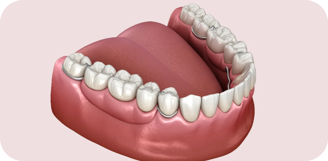 prothese-plurale-teintureries-tarare